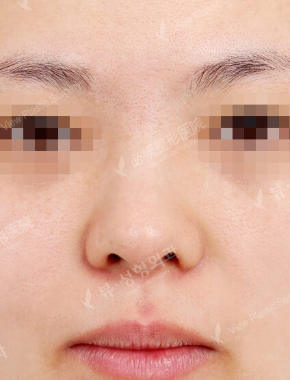 Bulbous Nose (Revisional Rhinoplasty) (1 Month) — Before