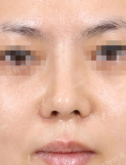 Bulbous Nose (Revisional Rhinoplasty) (1 Month) — After