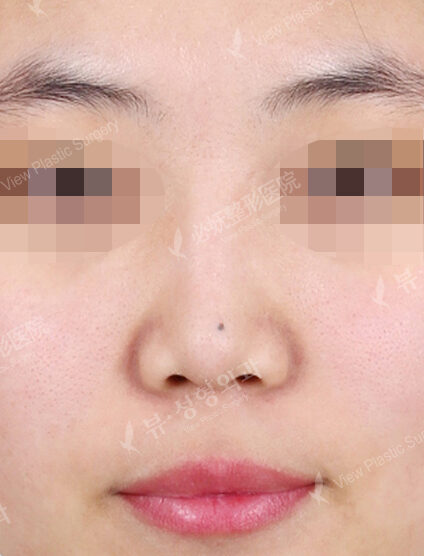 Low Nose (1 Month) — Before