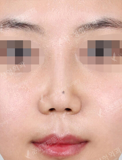 Low Nose (1 Month) — After