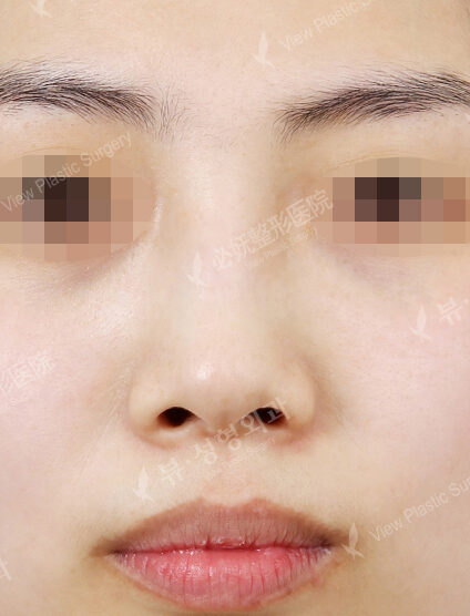 Hump Nose(1 Month) — Before