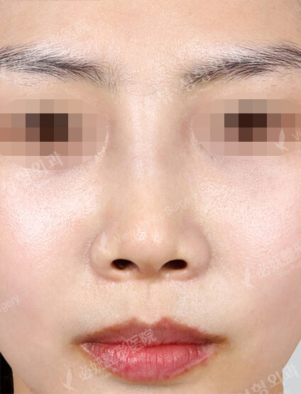 Hump Nose(1 Month) — After