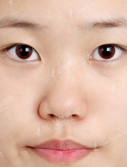 Low Nose (1 Month) — Before