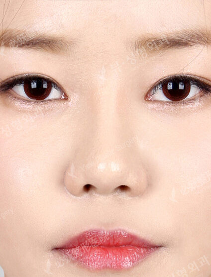 Low Nose (1 Month) — After