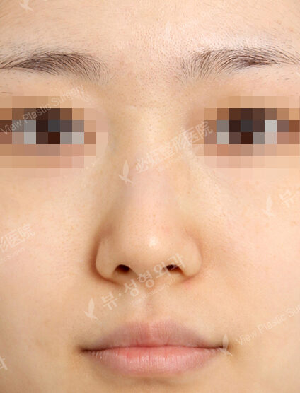Hump Nose(1 Month) — Before