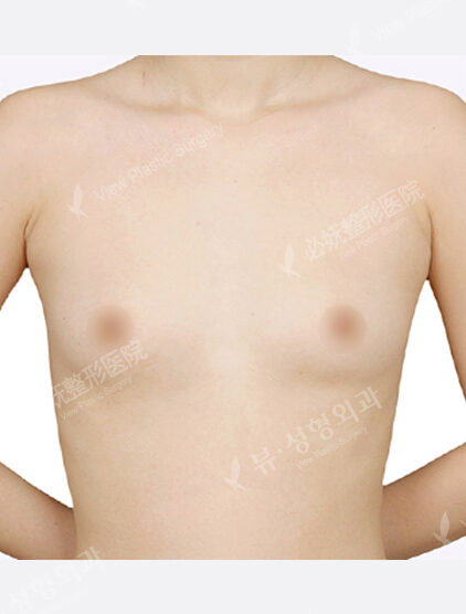 Breast Augmentation (1 Month) — Before
