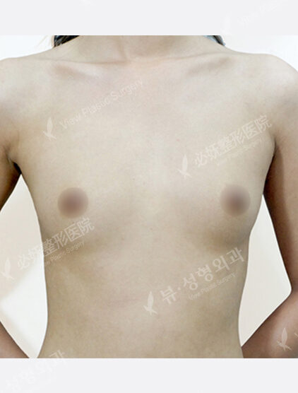 Breast Before