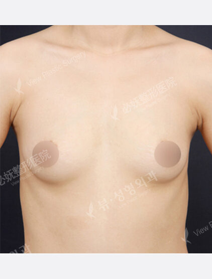 Breast Before