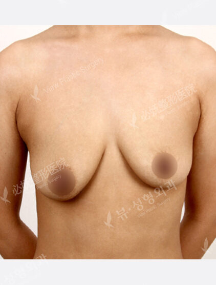 Breast Before