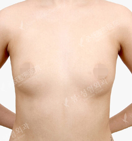 Breast Before
