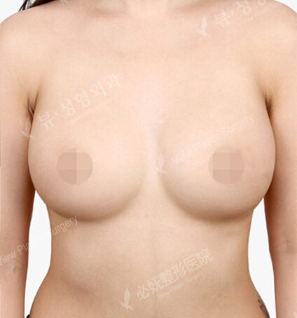 Breast After