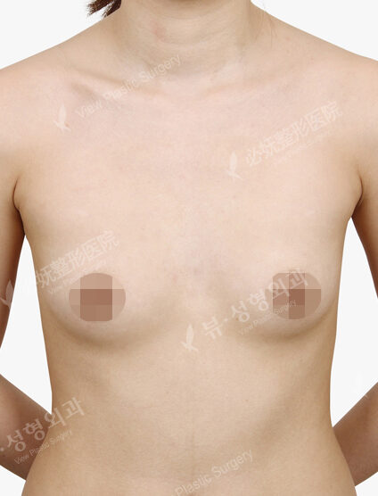 Breast Before