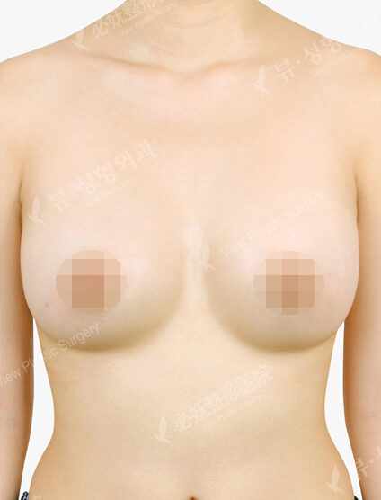 Breast After