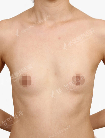 Breast Augmentation Tear Drop(1 Month) — Before