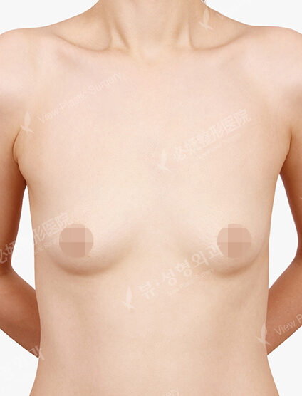 Breast Augmentation (5 Months) — Before