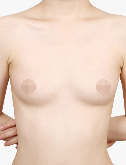 Breast Before