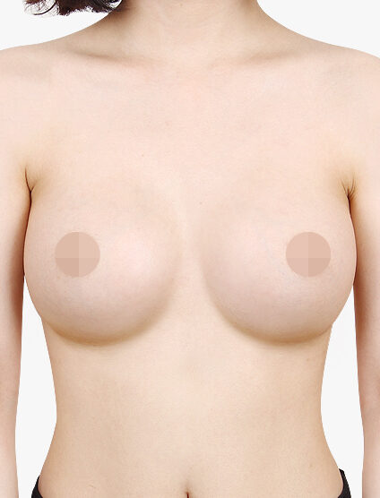 Breast After
