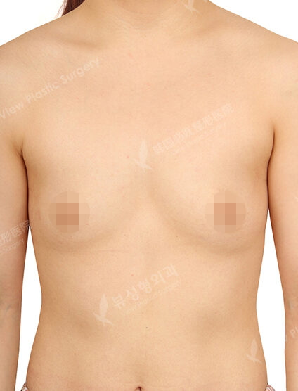 Breast Before