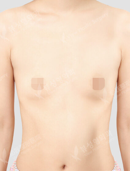 Breast Before