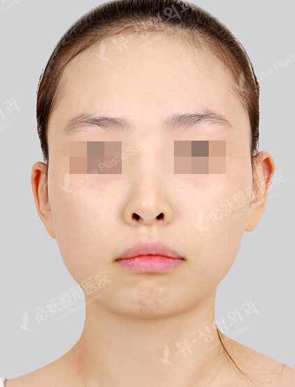 Protruding Mouth+Doll Line (Vline)+ Zygoma Reduction (1 Month) — Before