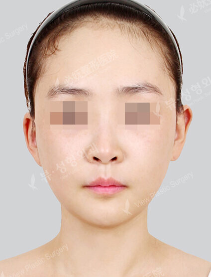 Protruding Mouth+Doll Line (Vline)+ Zygoma Reduction (1 Month) — After