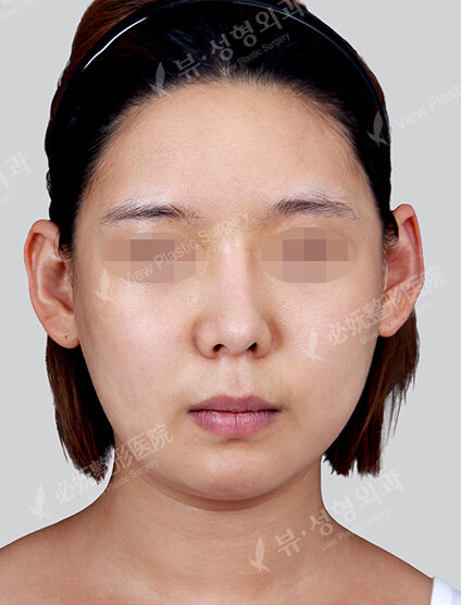 Natural Vline (Revisional Surgery)(1 Month) — Before