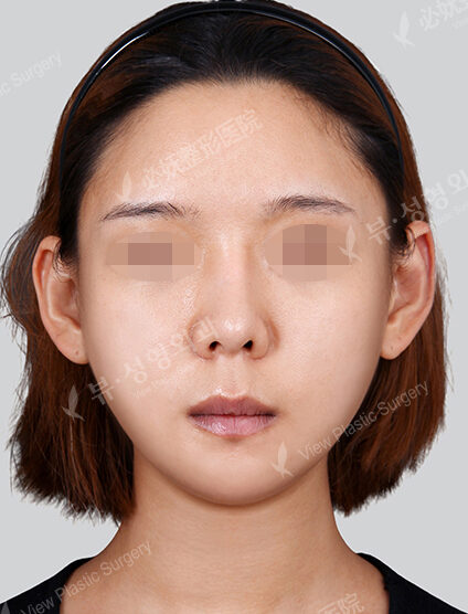Natural Vline (Revisional Surgery)(1 Month) — After
