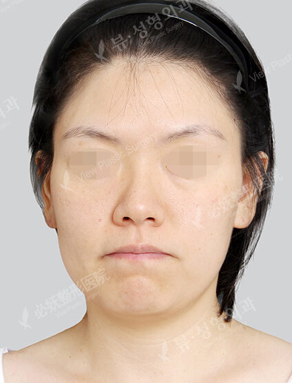 Natural Vline+Zygoma Reduction+Forehead Fat Graft (1 Month) — Before