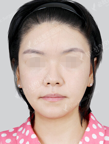 Natural Vline+Zygoma Reduction+Forehead Fat Graft (1 Month) — After