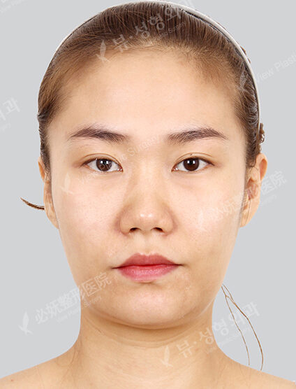 Natural Vline+Zygoma Reduction+Face Fat Graft (1 Month) — Before