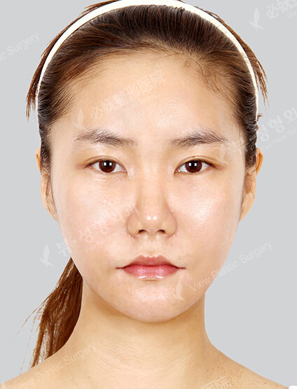 Natural Vline+Zygoma Reduction+Face Fat Graft (1 Month) — After