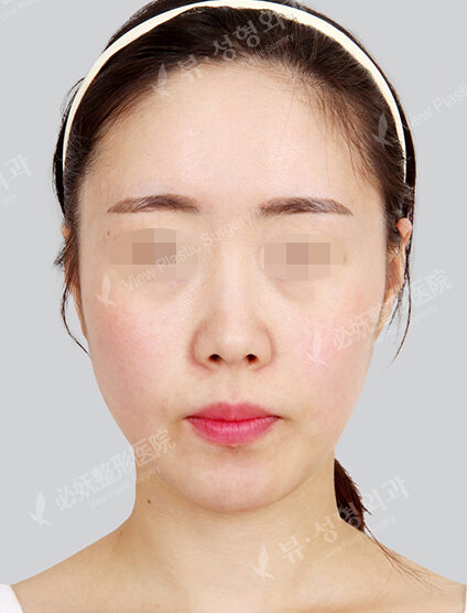 Forehead Reduction (1 Month) — Before