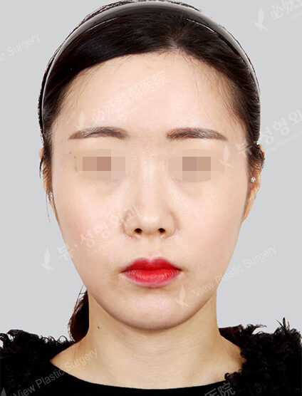 Forehead Reduction (1 Month) — After