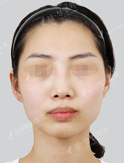 Doll Line (Vline)+ Zygoma Reduction+PA+Hump Nose(1 Month) — Before