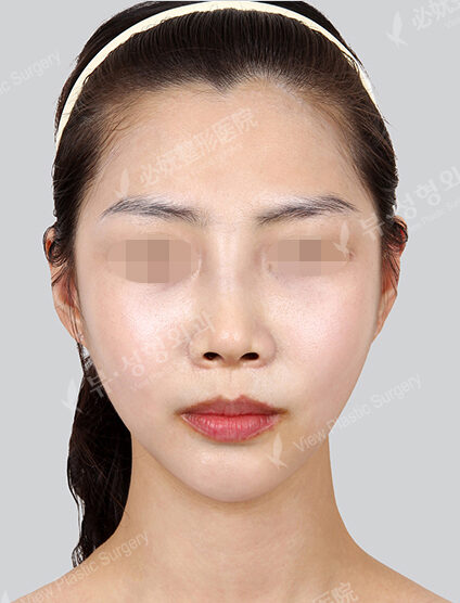 Doll Line (Vline)+ Zygoma Reduction+PA+Hump Nose(1 Month) — After