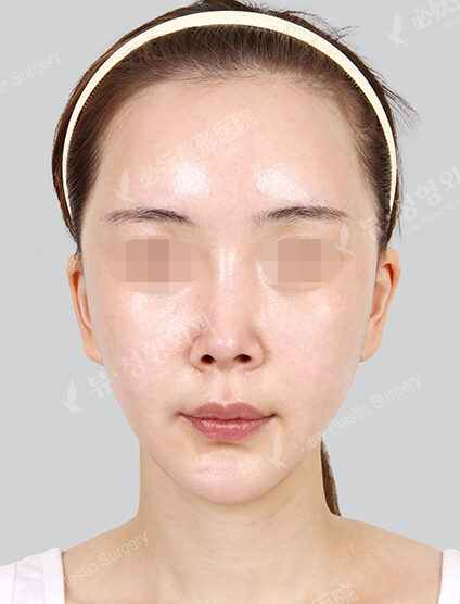 Zygoma Reduction (1 Month) — After