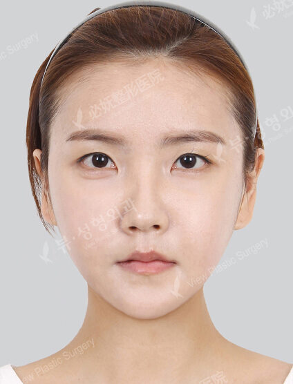 Natural Vline+Zygoma Reduction (1 Month) — After