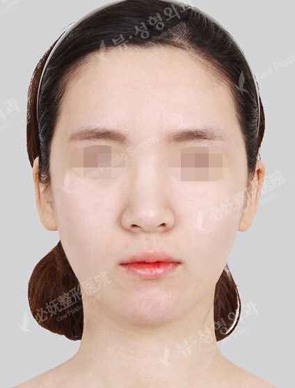 Angular Jaw Reduction (Revisional Surgery)+ Genioplasty (1 Month) — Before
