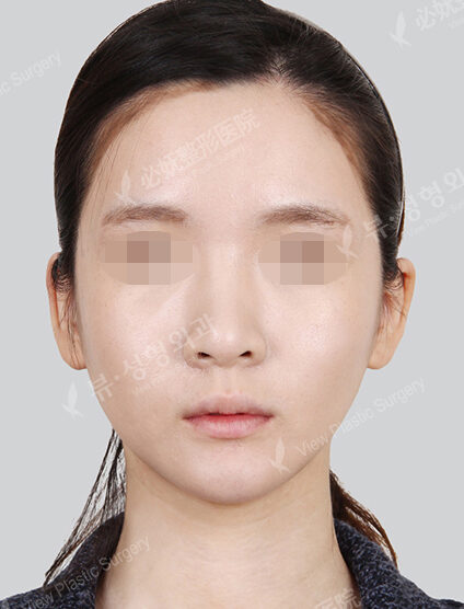 Angular Jaw Reduction (Revisional Surgery)+ Genioplasty (1 Month) — After