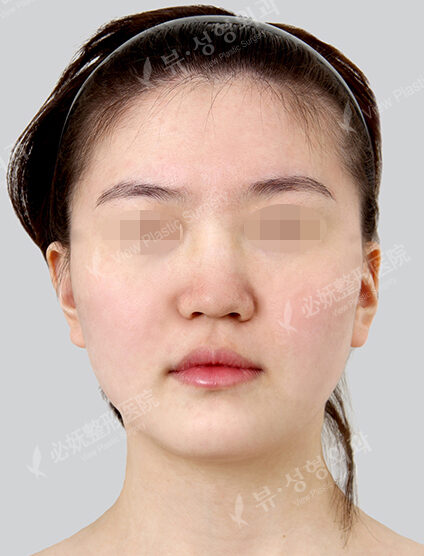 Natural Vline+Zygoma Reduction+PA+Rhinoplasty (1 Month) — Before