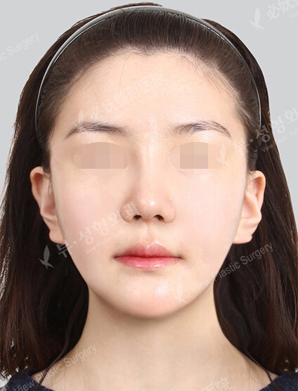 Natural Vline+Zygoma Reduction+PA+Rhinoplasty (1 Month) — After