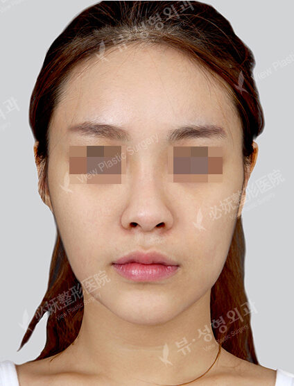 Natural Vline+Rhinoplasty (Revisional Surgery)(1 Month) — Before