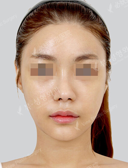 Natural Vline+Rhinoplasty (Revisional Surgery)(1 Month) — After