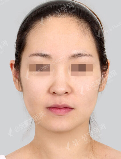 Natural Vline+Zygoma Reduction+PA+Forehead Implant+Rhinoplasty (1 Month) — Before
