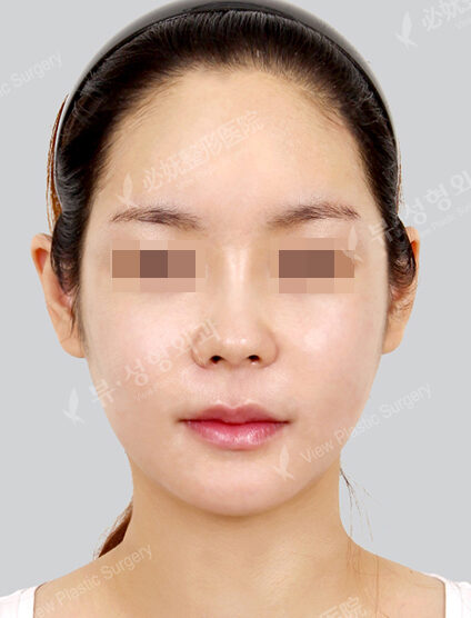 Natural Vline+Zygoma Reduction+PA+Forehead Implant+Rhinoplasty (1 Month) — After