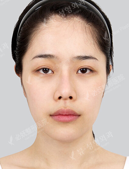 Facial Contouring Before