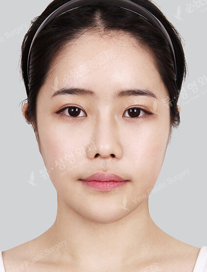 Facial Contouring After