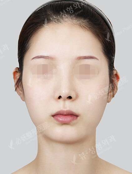 Natural Vline+Zygoma Reduction+Forehead Implant (1 Month) — Before