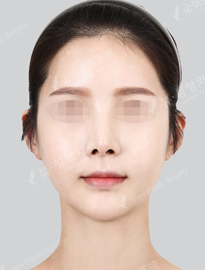 Natural Vline+Zygoma Reduction+Forehead Implant (1 Month) — After
