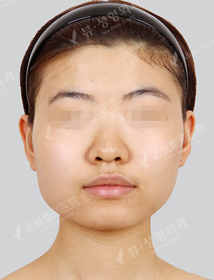 Facial Contouring Before